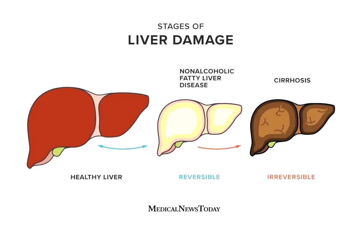 Fatty Liver: फैटी लिवर शरीर के अंग को कर सकता है क्षतिग्रस्त हो जाये सावधान !