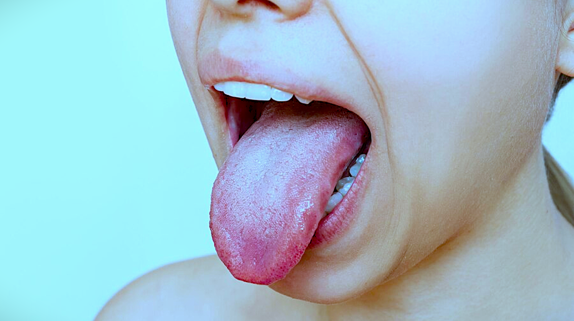 Mouth Ulcers : मुंह के छालों से छुटकारा पाने के लिए अपनाये घरेलू उपाय