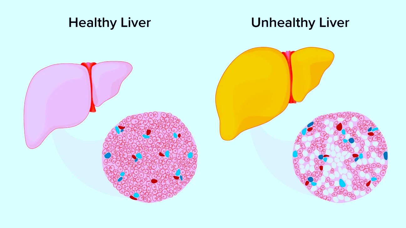 Fatty Liver : फैटी लिवर की समस्या जानिए इसके कारण, लक्षण और बचाव के उपाय